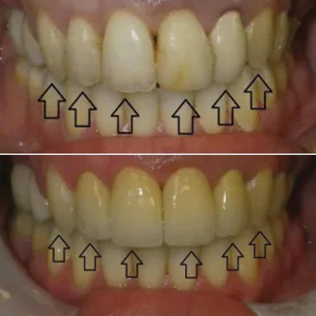 4 Front Tooth Crowns and Restorative Treatment to the 3rd Tooth