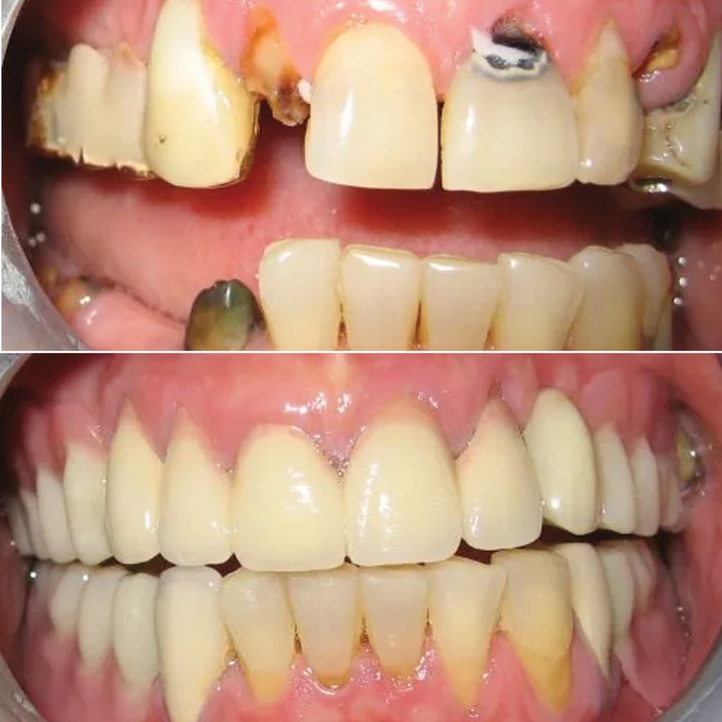 Crowns & Removable Attachment Partial Dentures With Hidden Clasp