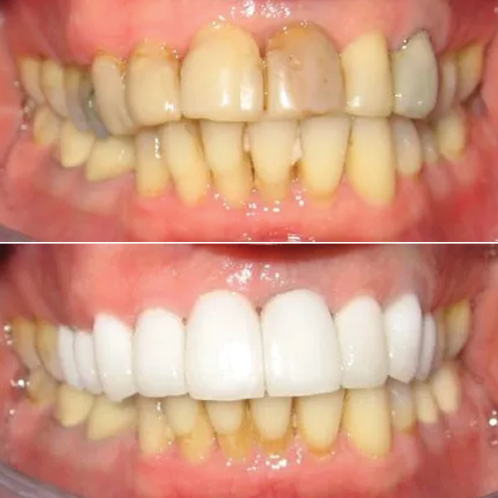 Full Porcelain Replacement Crowns