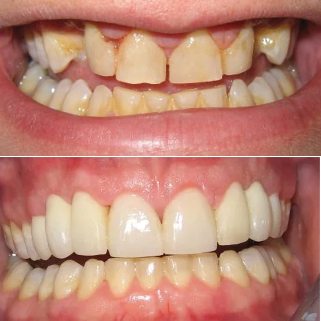 Full Upper Porcelain Crowns and Bridges