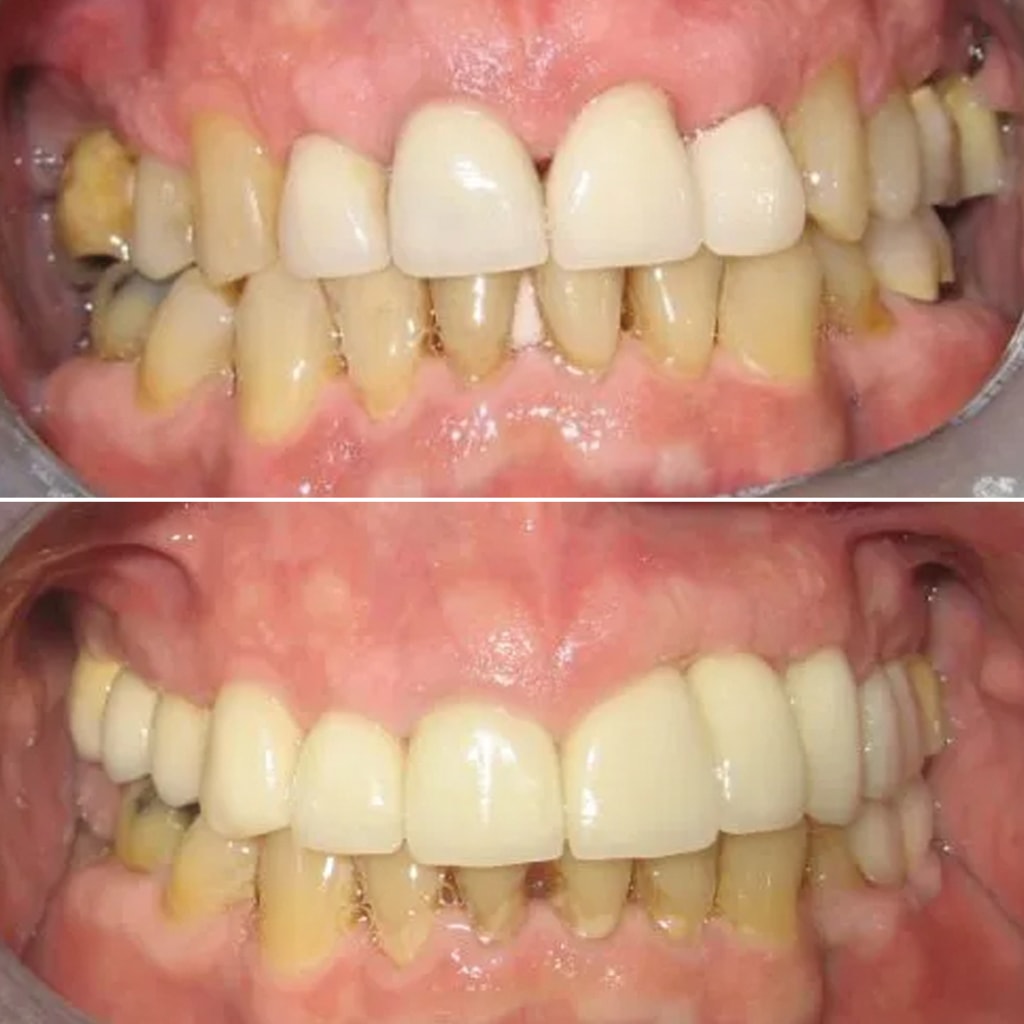 Full Upper Porcelain Crowns Including Two Dental Implants