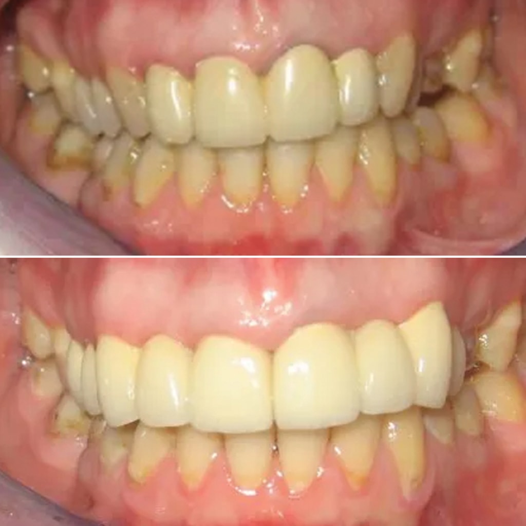 Full Upper Porcelain Crowns Including Two Dental Implants