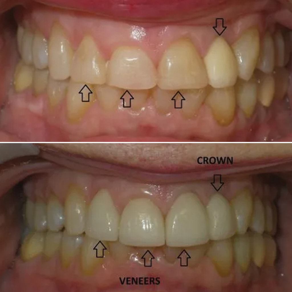 3 Porcelain Veneers and 1 Crown
