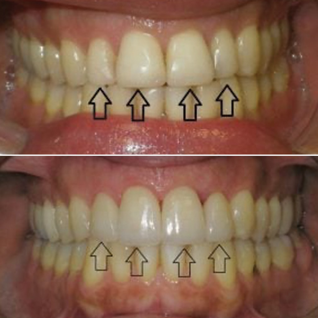 4 Front Teeth Veneers