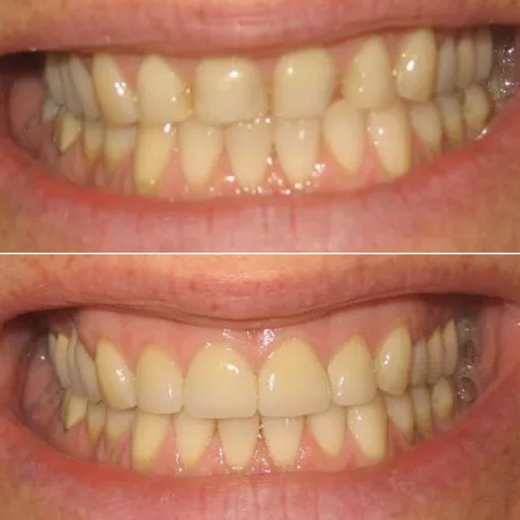 4 Veneers Upper Front Teeth