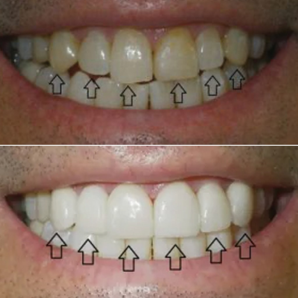 6 Front Teeth Veneers