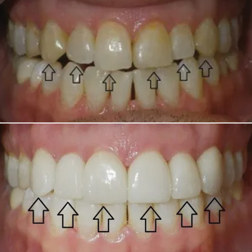 6 Front Teeth Veneers