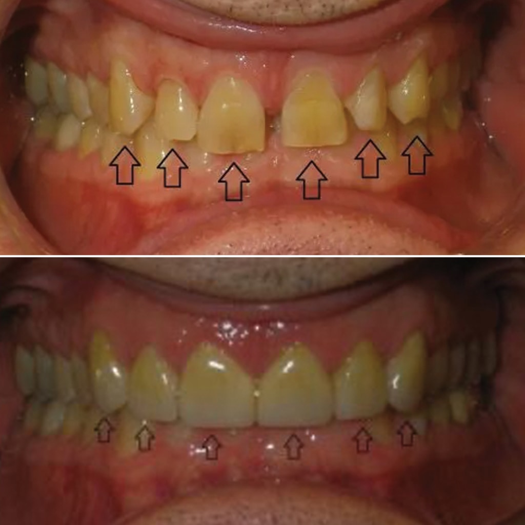 6 Front Teeth Veneers
