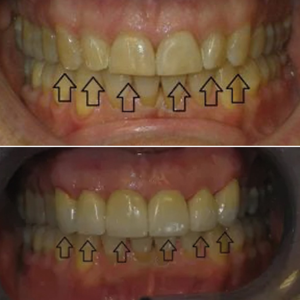 6 Front Teeth Veneers