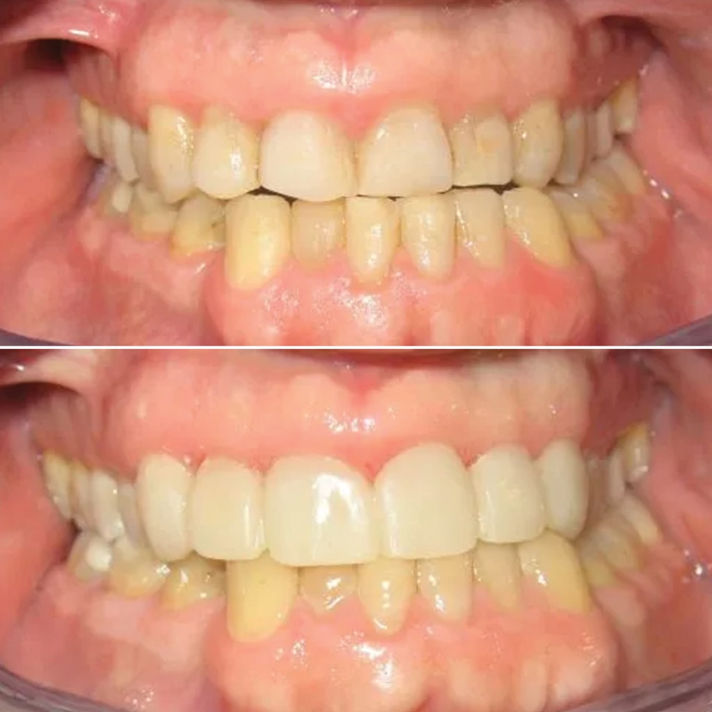 6 Veneers Upper Front Teeth