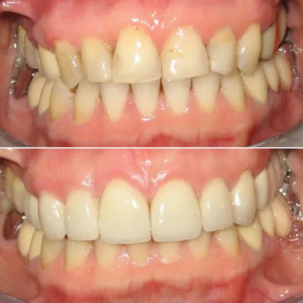 Porcelain Veneers and Fixed Bridgework