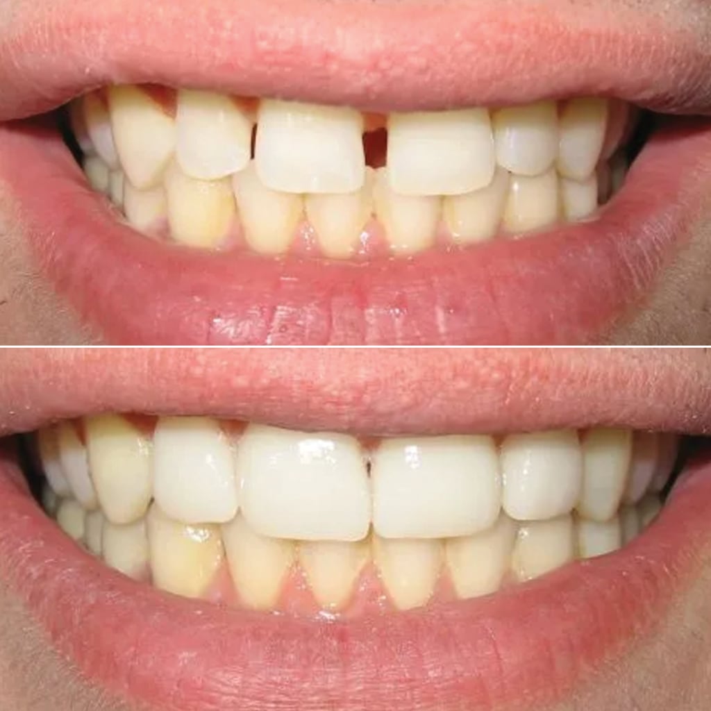 Veneers to Close Gaps