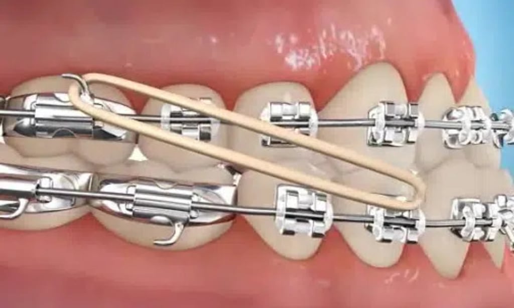 Class III elastics can be used to correct an underbite