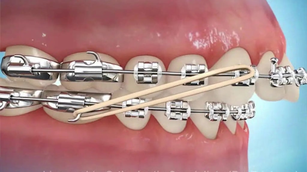 Class II elastics can be used to correct an overbite
