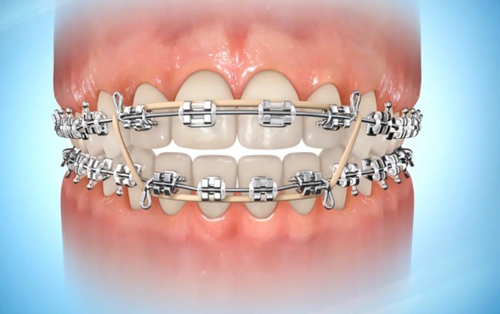 Box elastics can be used to close an open bite