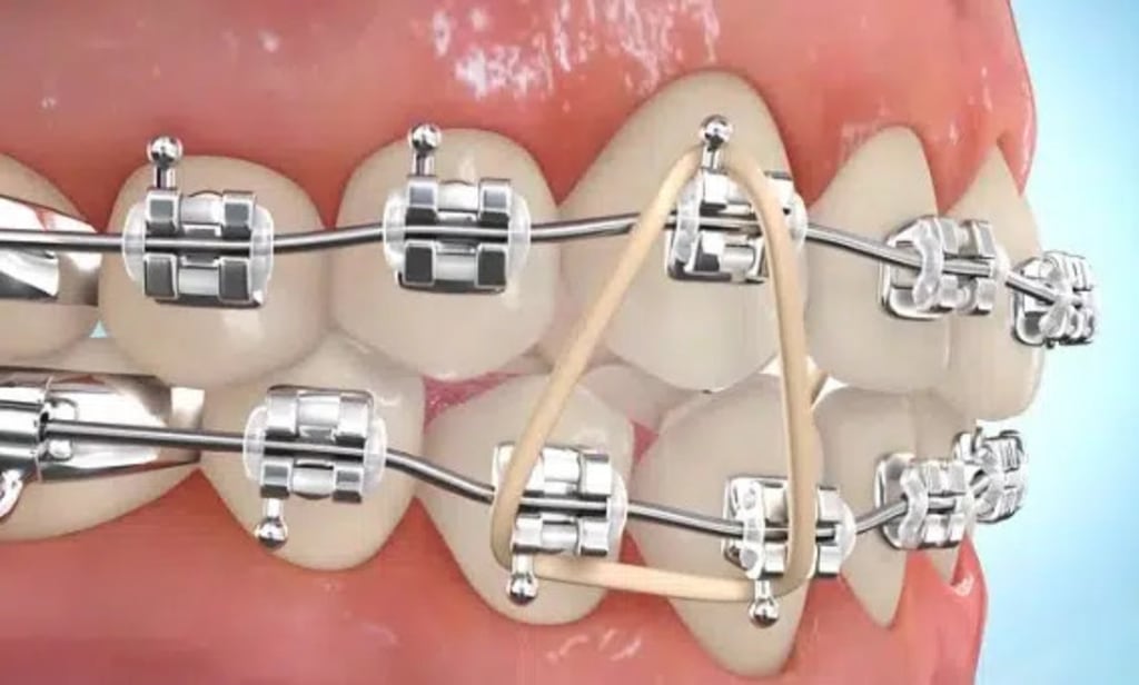 Triangle elastics can be used to close bites.