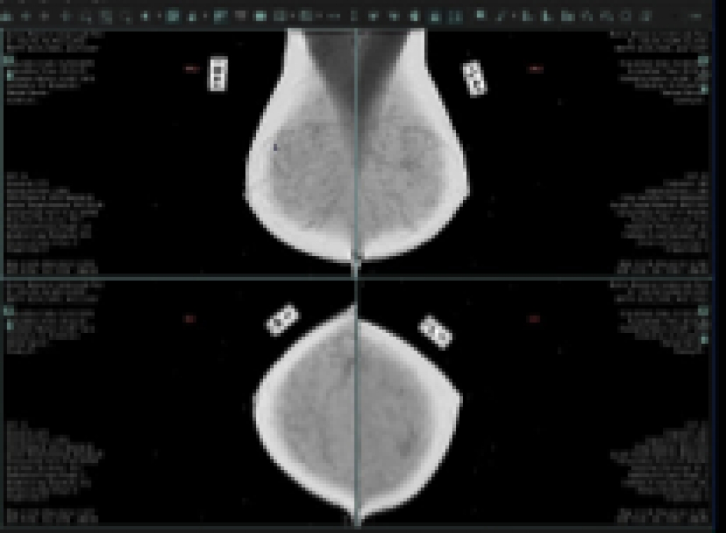 ge healthcare digital breast tomosynthesis ge healthcare digital breast tomosynthesis