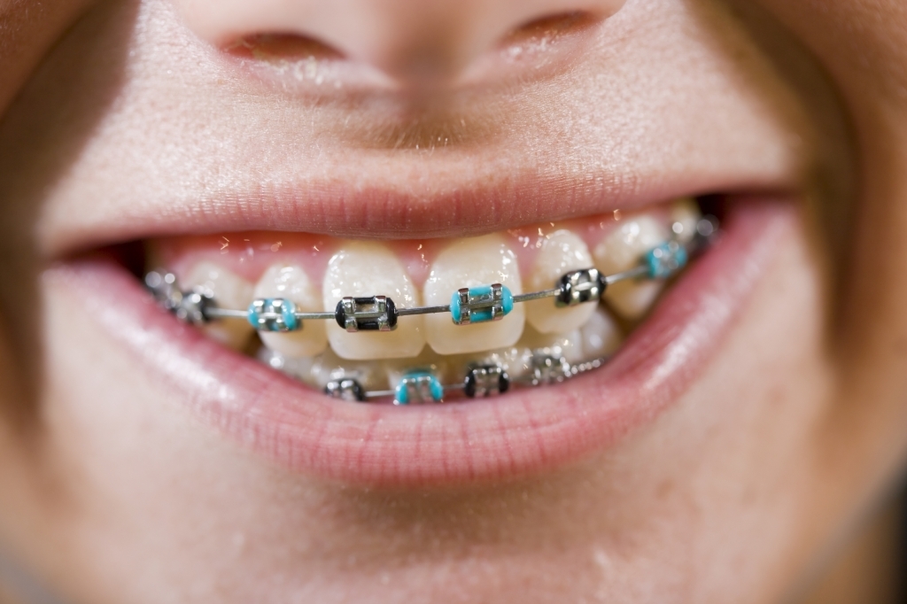 orthodontist braces color wheel